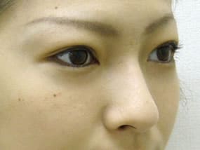 目の下のクマ・タルミ症例手術３ヶ月後
