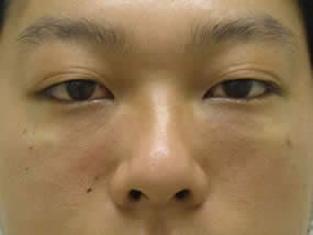 目の下のクマ・タルミ症例手術直後