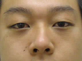 目の下のクマ・タルミ症例手術１ヵ月後