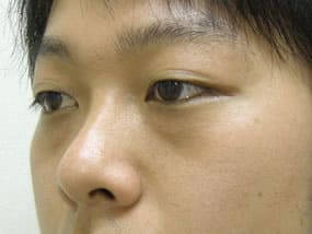 目の下のクマ・タルミ症例手術前