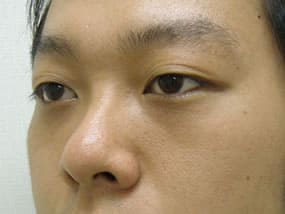 目の下のクマ・タルミ症例手術３ヶ月後