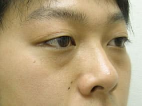 目の下のクマ・タルミ症例手術前