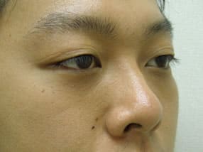 目の下のクマ・タルミ症例手術３ヶ月後