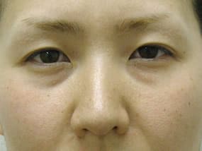 目の下のクマ・タルミ症例手術前