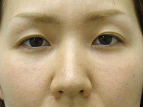 目の下のクマ・タルミ症例手術３ヶ月後