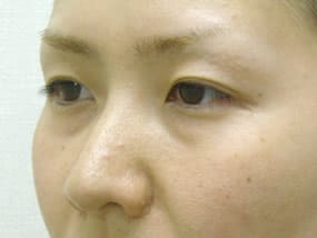 目の下のクマ・タルミ症例手術前