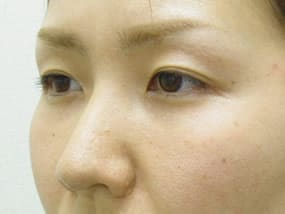 目の下のクマ・タルミ症例手術３ヶ月後