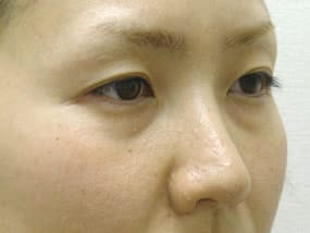 目の下のクマ・タルミ症例手術前