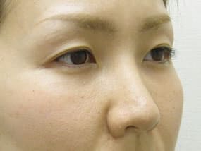 目の下のクマ・タルミ症例手術３ヶ月後