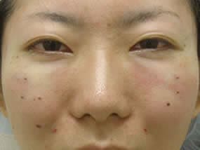 目の下のクマ・タルミ症例手術直後（メイクなし）