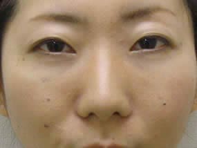 目の下のクマ・タルミ症例手術２日後（メイクあり）