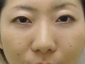 目の下のクマ・タルミ症例手術１週間後（メイクあり）