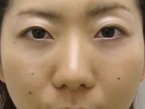 目の下のクマ・タルミ症例手術２週間後（メイクあり）