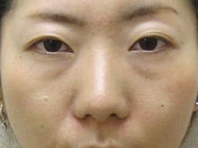 目の下のクマ・タルミ症例手術前
