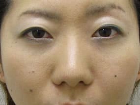 目の下のクマ・タルミ症例手術３ヶ月後