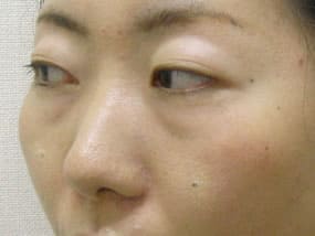 目の下のクマ・タルミ症例手術前
