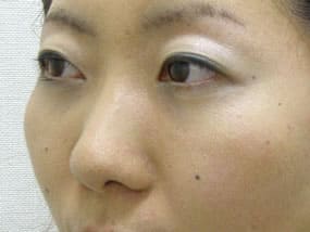 目の下のクマ・タルミ症例手術３ヶ月後