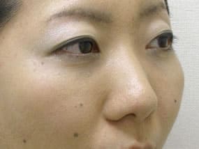 目の下のクマ・タルミ症例手術３ヶ月後