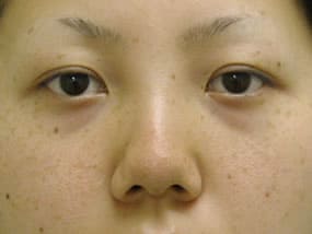 目の下のクマ・タルミ症例手術前