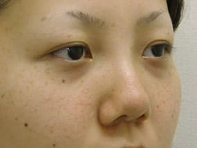 目の下のクマ・タルミ症例手術前