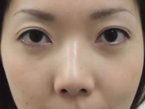 目の下のクマ・タルミ症例手術２ヶ月後