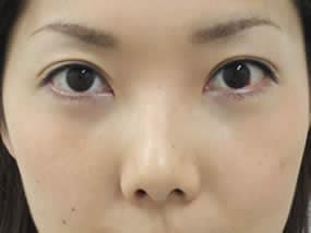 目の下のクマ・タルミ症例手術２日後（メイクあり）