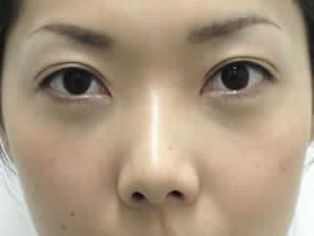 目の下のクマ・タルミ症例手術１週間後（メイクあり）