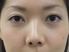 目の下のクマ・タルミ症例手術１ヵ月後（メイクあり）