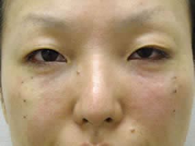 目の下のクマ・タルミ症例手術直後（メイクなし）