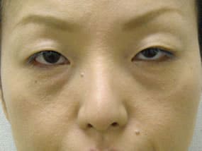 目の下のクマ・タルミ症例手術前