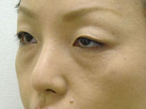 目の下のクマ・タルミ症例手術前