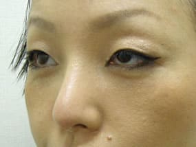 目の下のクマ・タルミ症例手術３ヶ月後