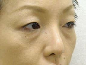 目の下のクマ・タルミ症例手術前