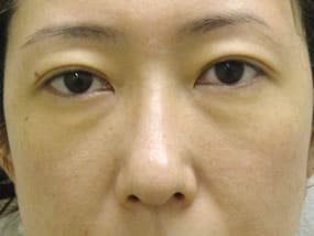 目の下のクマ・タルミ症例手術前