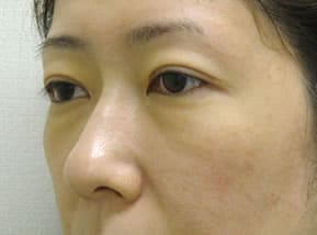 目の下のクマ・タルミ症例手術前