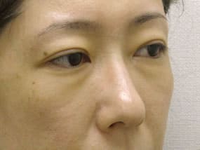 目の下のクマ・タルミ症例手術前