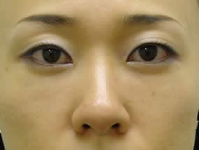 目の下のクマ・タルミ症例手術１ヵ月後（メイクあり）