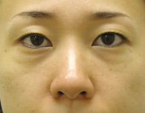 目の下のクマ・タルミ症例手術前