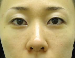 目の下のクマ・タルミ症例手術３ヶ月後