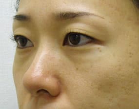 目の下のクマ・タルミ症例手術前