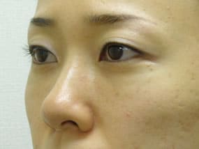 目の下のクマ・タルミ症例手術３ヶ月後