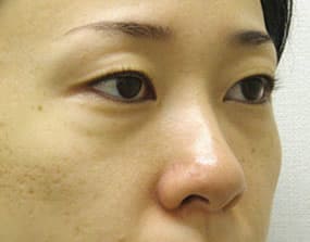 目の下のクマ・タルミ症例手術前