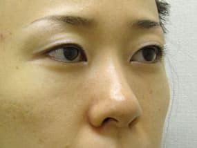 目の下のクマ・タルミ症例手術３ヶ月後
