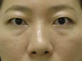 目の下のクマ・タルミ症例手術前（メイクあり）