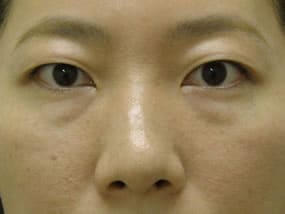 目の下のクマ・タルミ症例手術前