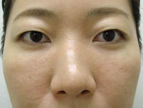 目の下のクマ・タルミ症例手術３ヶ月後