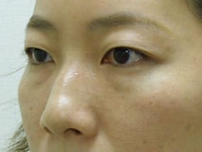 目の下のクマ・タルミ症例手術前