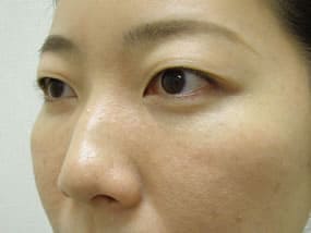目の下のクマ・タルミ症例手術３ヶ月後