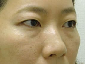 目の下のクマ・タルミ症例手術前