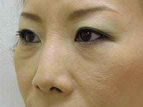 目の下のクマ・タルミ症例手術前